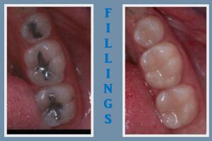 699_fillings-amalgams_and_composites