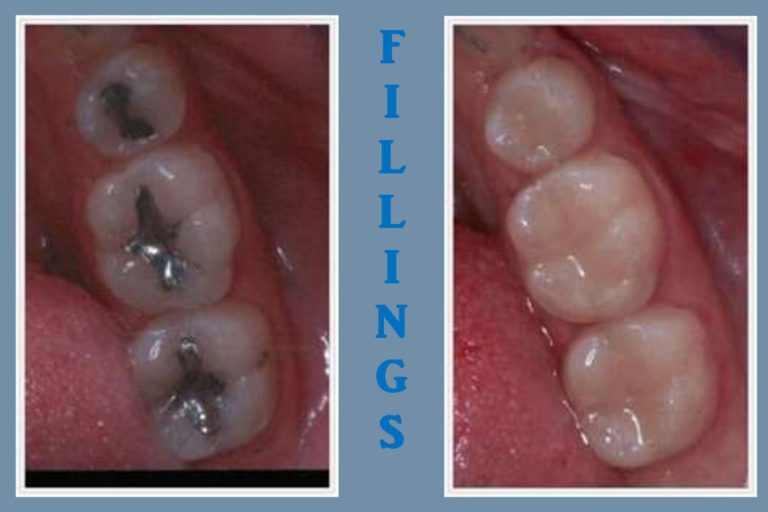 Dental Fillings Seaman Family Dentistry