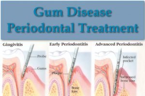 699_gum-disease