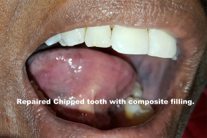 chip_tooth_postop_7_comp_closeup